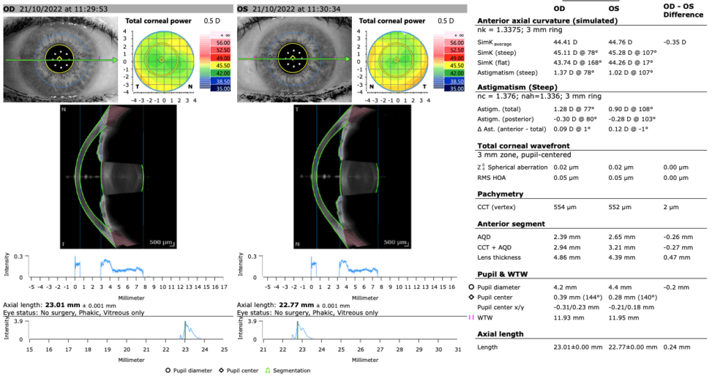 Biometria Ptica Iol Perdizes